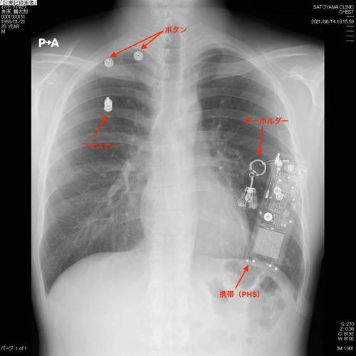 X線画像 胸部X線画像病変検出ソフトウェア CXR-AID（シーエックスアール ...
